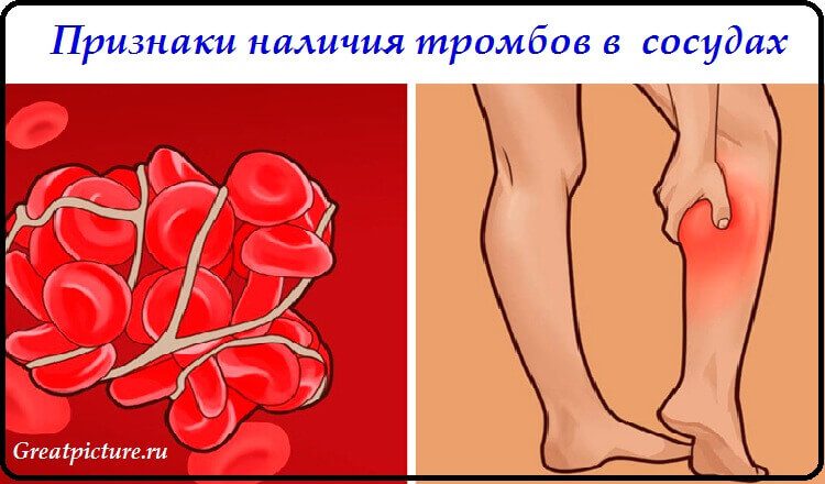 Важные признаки, что у вас появились тромбы в кровеносных сосудах